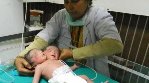 Ινδία Γεννήθηκε μωρό με δύο κεφάλια