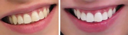 δόντια-πριν-και-μετά