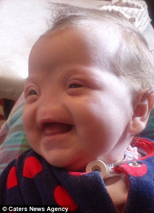 απίστευτο-κοριτσάκι-γεννήθηκε-χωρίς-μύτη-1