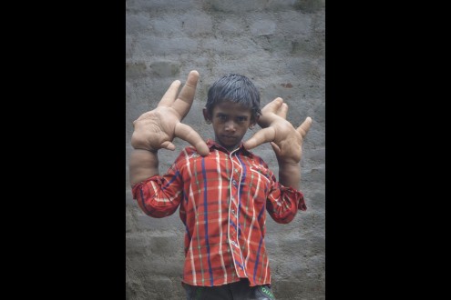 o-8χρονος-με-τα-τεράστια-χέρια-δίνει-την-δικιά-του-μάχη-1