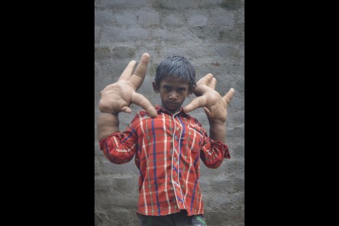 o-8χρονος-με-τα-τεράστια-χέρια-δίνει-την-δικιά-του-μάχη-1