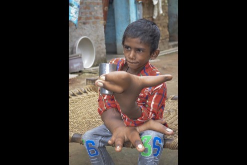 o-8χρονος-με-τα-τεράστια-χέρια-δίνει-την-δικιά-του-μάχη-4