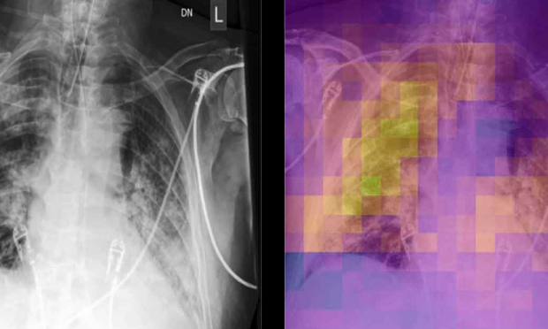 Deep COVID-XR