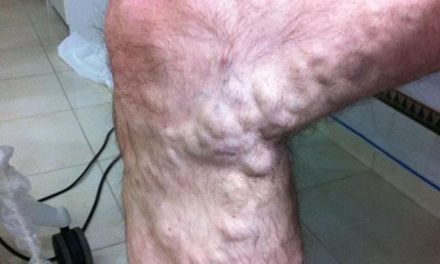 thromvosi-sta-podia
