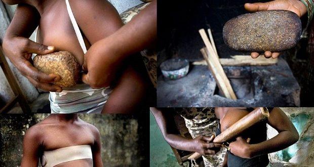 Σιδέρωμα στήθους: Μια φρικτή και απάνθρωπη πρακτική για μικρά κορίτσια