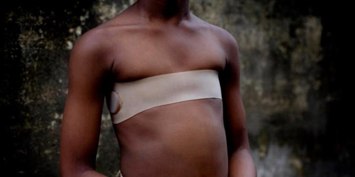 Σιδέρωμα στήθους: Μια φρικτή και απάνθρωπη πρακτική για μικρά κορίτσια