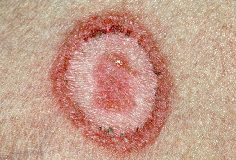 (Tinea Corporis)