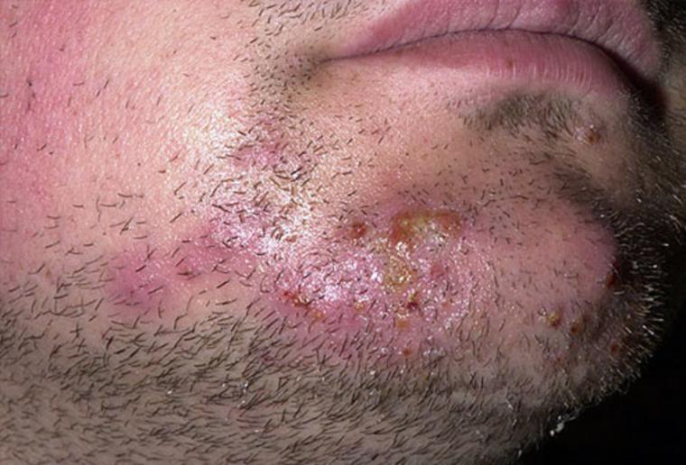 Ringworm στα γένια