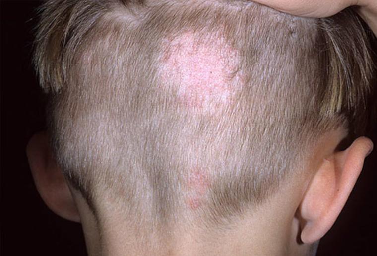 Tinea capitis)