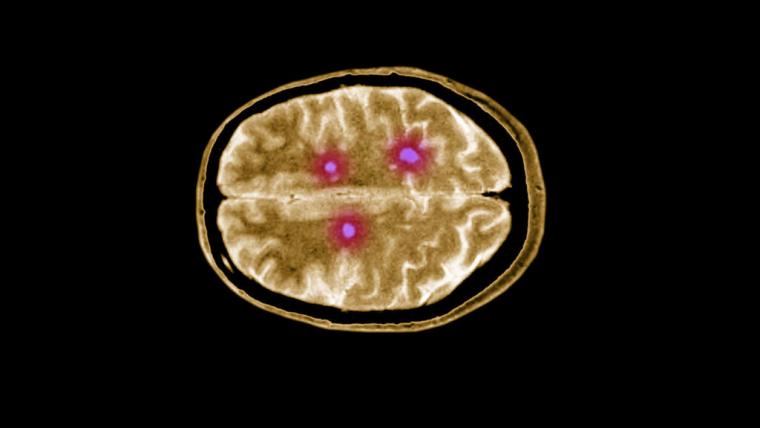 Πολλαπλή σκλήρυνση: Η κούραση που προκαλεί η χρόνια πάθηση που καταστρέφει τα νεύρα, έχει πολλές αιτίες. Τα προβλήματα της ουροδόχου κύστης και οι μυϊκοί σπασμοί, προκαλούν συχνές αφυπνίσεις. Η κατάθλιψη, συχνή στα άτομα με σκλήρυνση, συμβαδίζει με την κούραση και καθιστά αδύνατη την εκτέλεση ακόμη και απλών καθημερινών λειτουργιών, όπως το βούρτσισμα των δοντιών. Υπάρχει όμως και η κόπωση της πολλαπλής σκλήρυνσης, η οποία είναι πιο σοβαρή, καθημερινή και επιδεινώνεται από παράγοντες, όπως η θερμότητα και η