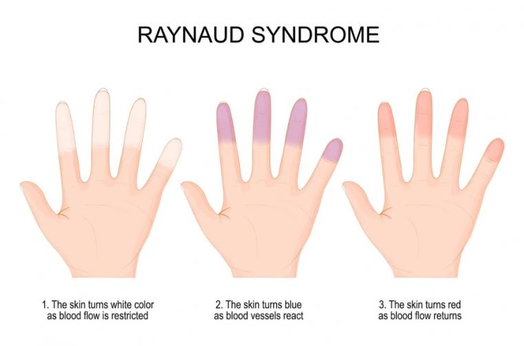 raynaud