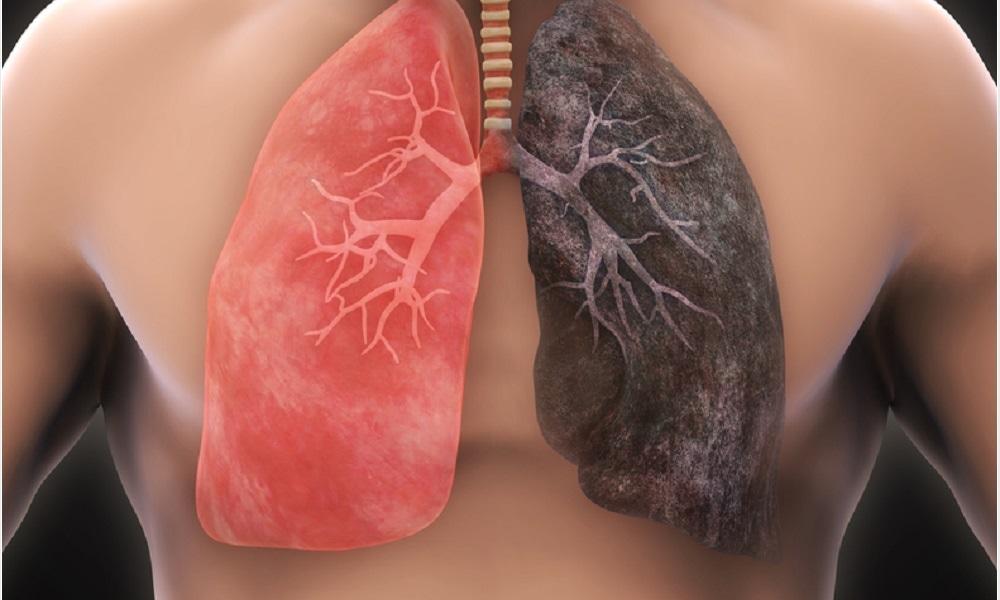 καρκινος πνευμονα