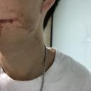 αφαίρεση φρονιμίτη