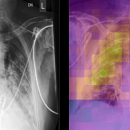 Deep COVID-XR