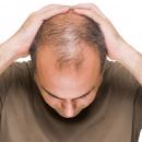 ανδρική φαλάκρα