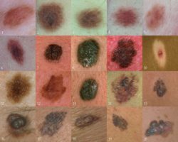 multiblemelanomas